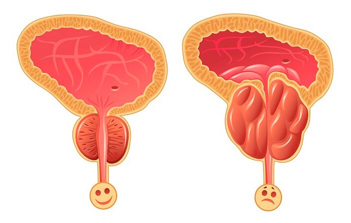 Prostată normală și inflamată