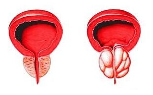 Prostată în stare normală (stânga) și inflamată cu prostatită (dreapta)