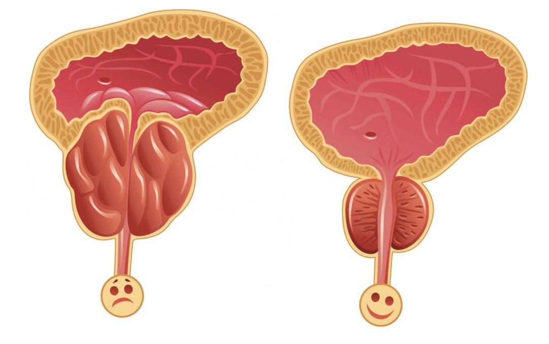 Inflamația prostatei cu prostatita (stânga) și a glandei prostatei este normală (dreapta)